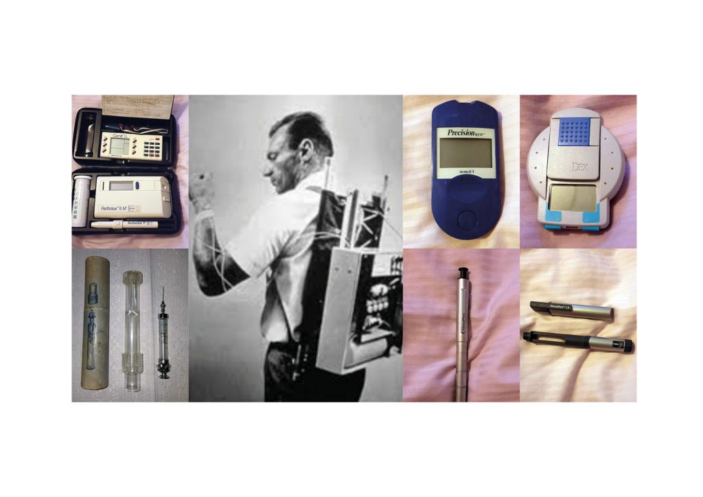 När den första insulinpumpen kom var den stor som en rejäl ryggsäck och sågs som science fiction. Idag får pumpen plats under tröjan. Vardagen med diabetes är fortfarande både krånglig och frustrerande. Men utvecklingen av nya hjälpmedel och behandlingar har aldrig varit snabbare än nu.
Läs en personlig hjälpmedelsresa från dyra färgteststickor till realtidsvärden i armbandsklockan.